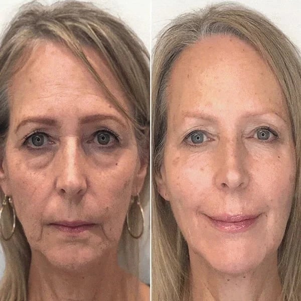 đ„Botox Face Serum