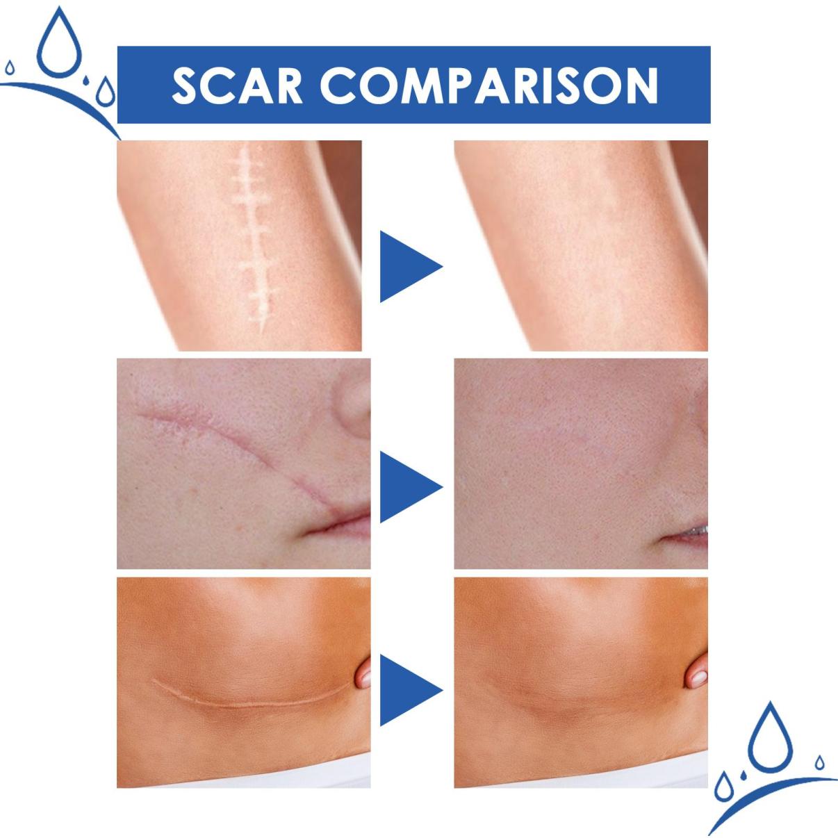 Natural Scar Cream – Fast Results, Safe for All Skin