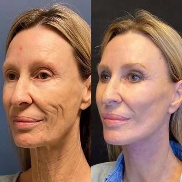 đ„Botox Face Serum