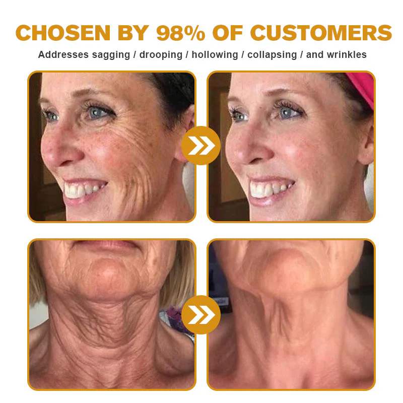 👨‍⚕️ LAST DAY 49% OFF✅  Botox Bee Venom Wrinkle Removal Cream