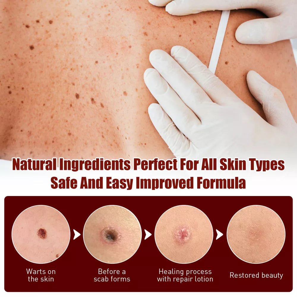 Tags & Moles Remover – Quick & Scar-Free Solution for Skin Tags & Warts