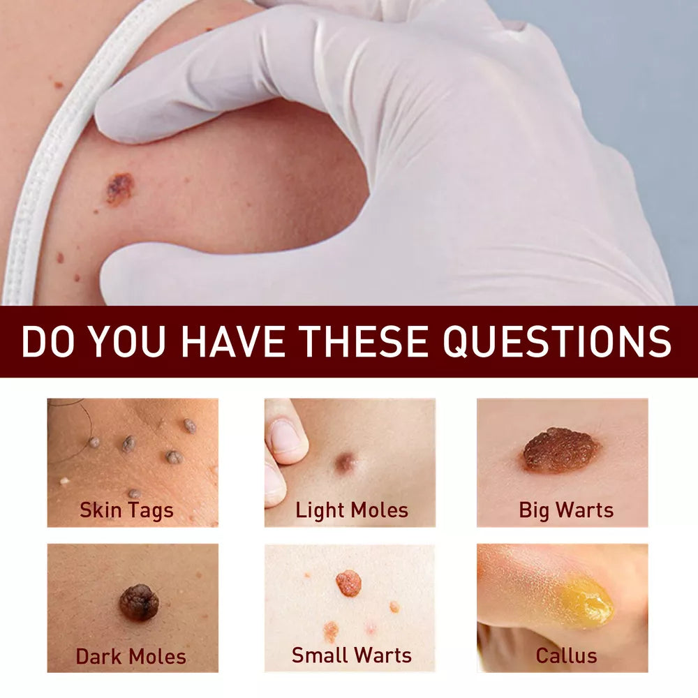 Tags & Moles Remover – Quick & Scar-Free Solution for Skin Tags & Warts