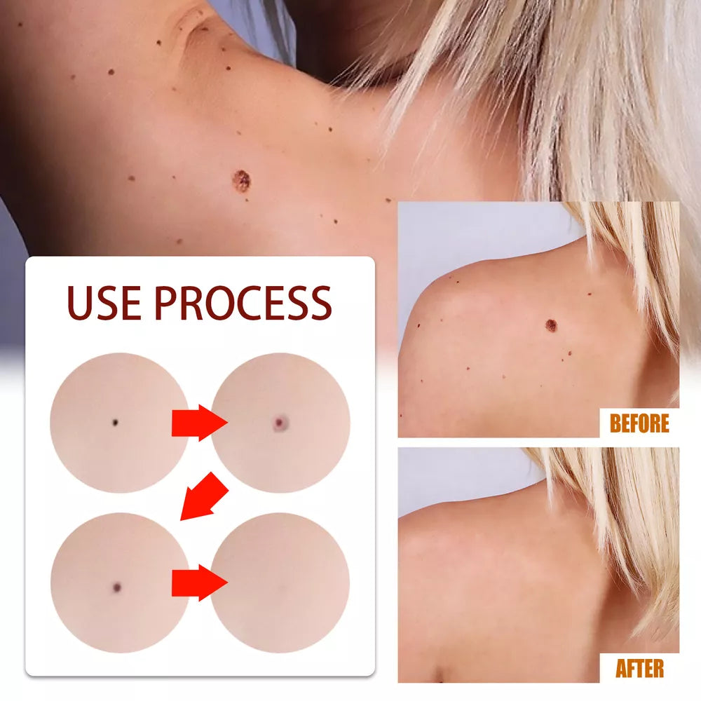 Tags & Moles Remover – Quick & Scar-Free Solution for Skin Tags & Warts