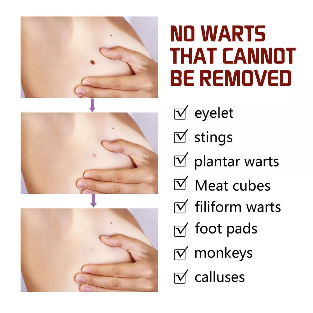 Tags & Moles Remover – Quick & Scar-Free Solution for Skin Tags & Warts