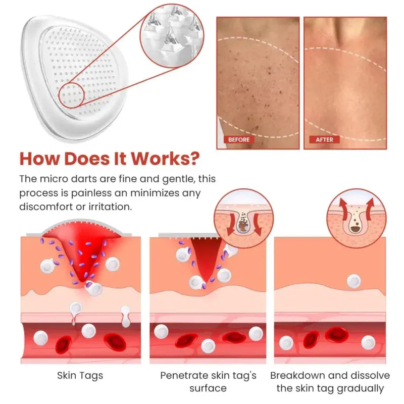 Skin Tag Removal Patch