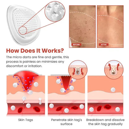Skin Tag Removal Patch